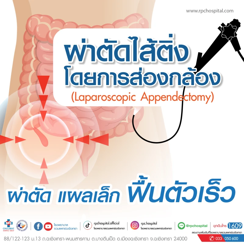 ผ่าตัดไส้ติ่ง โดยการส่องกล้อง