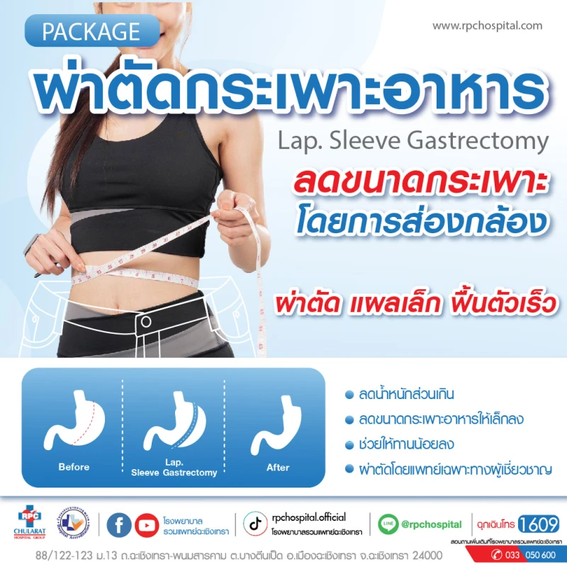 Package ผ่าตัดกระเพาะอาหาร