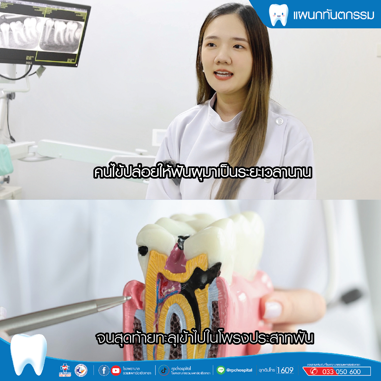 ฟันผุทะลุโพรงประสาทคืออะไร รักษาได้ไหม - ความรู้สุขภาพ - โรงพยาบาลรวมแพทย์ฉะเชิงเทรา