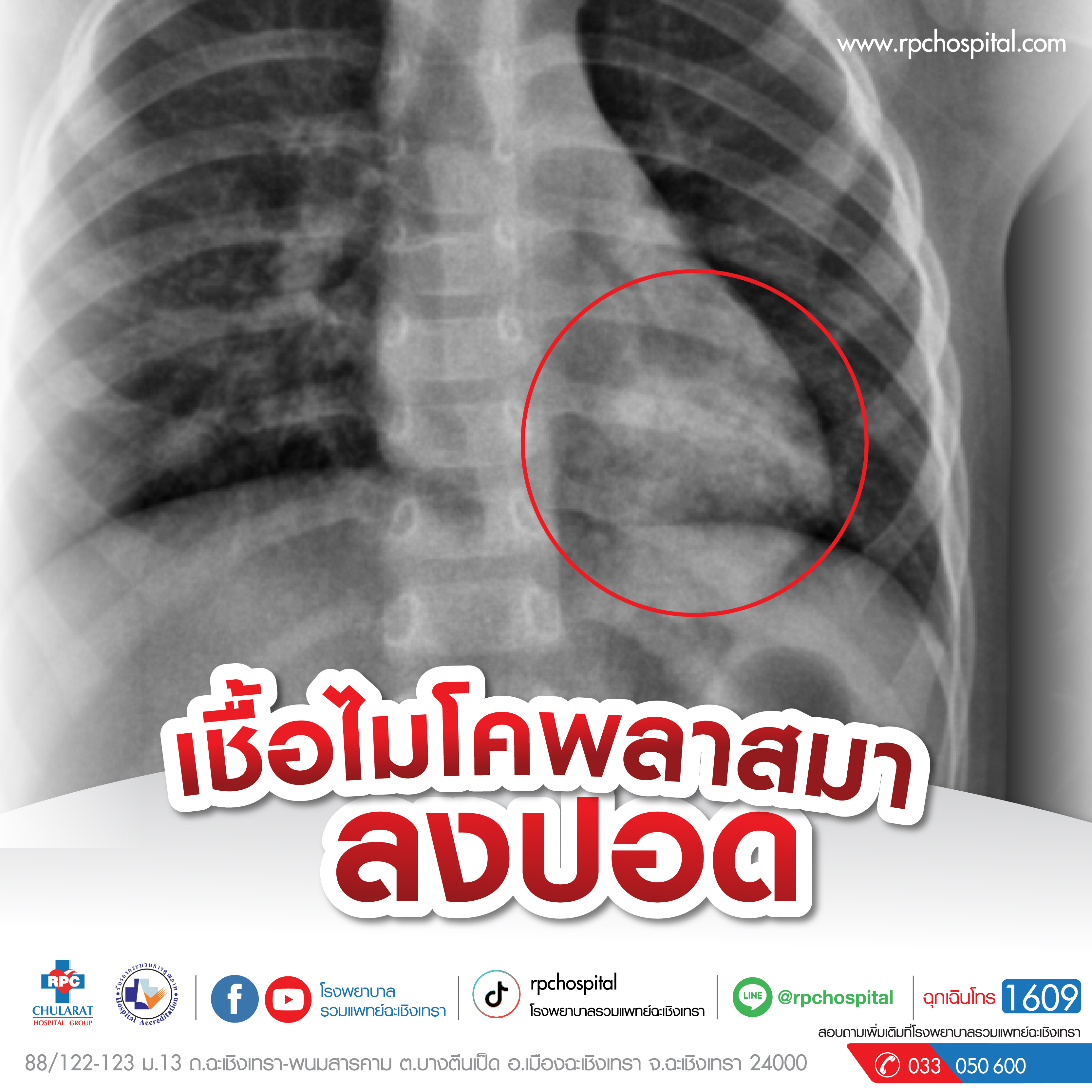 ไมโคพลาสมา (Mycoplasma) - ความรู้สุขภาพ - โรงพยาบาลรวมแพทย์ฉะเชิงเทรา