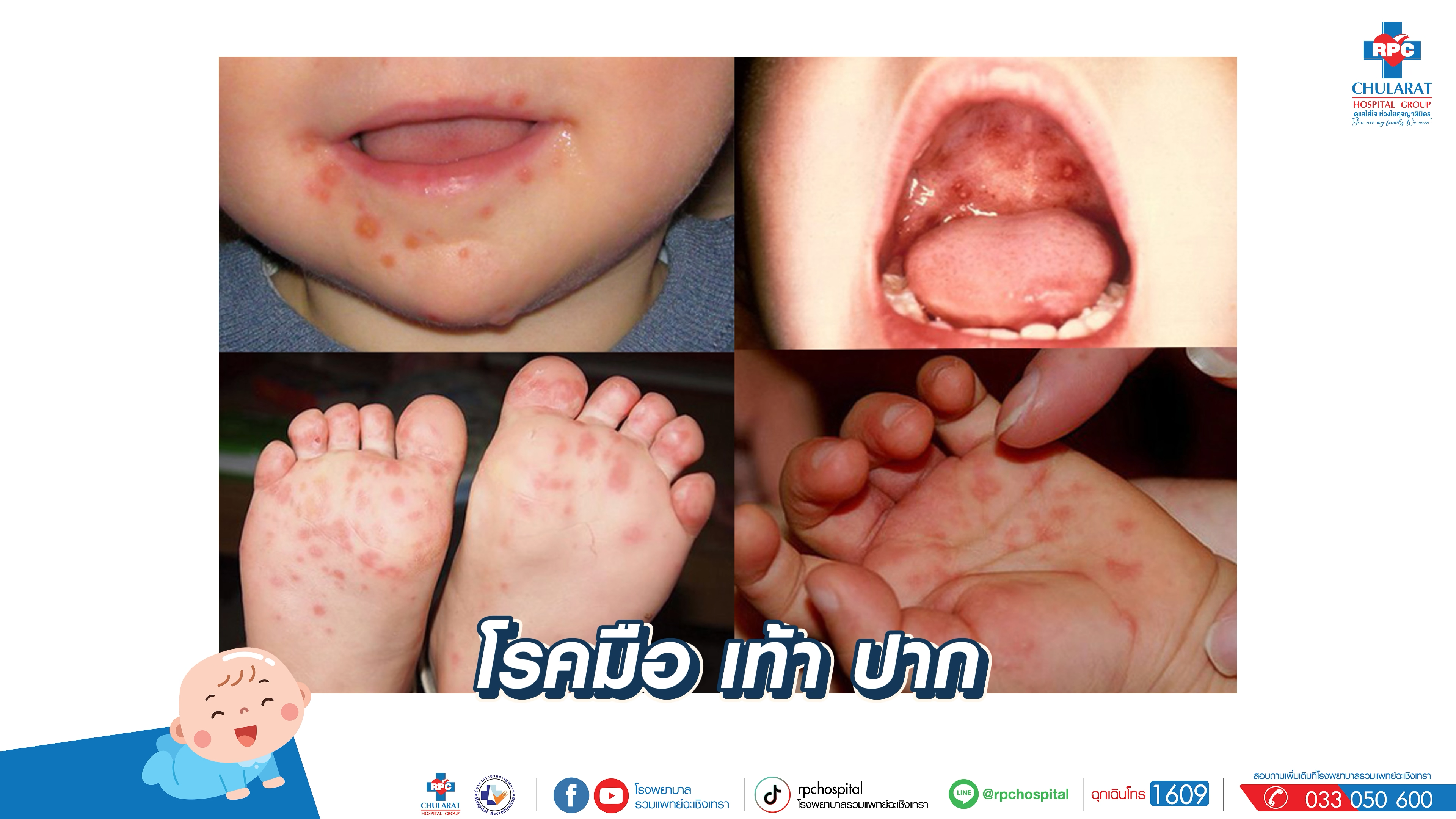 5 โรคที่เด็กป่วยบ่อย - ความรู้สุขภาพ - Ruampat Chachoengsao Hosptial